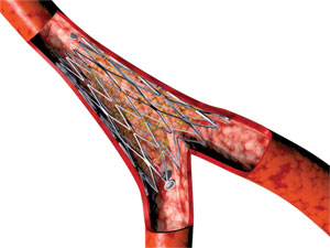 Biosensor---axxess-stent-le